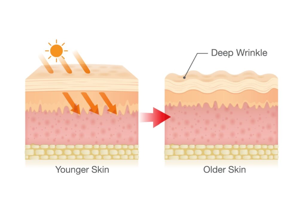 Medical diagram comparing younger skin to older skin showing how sun exposure causes collagen breakdown and deep wrinkle formation over time.