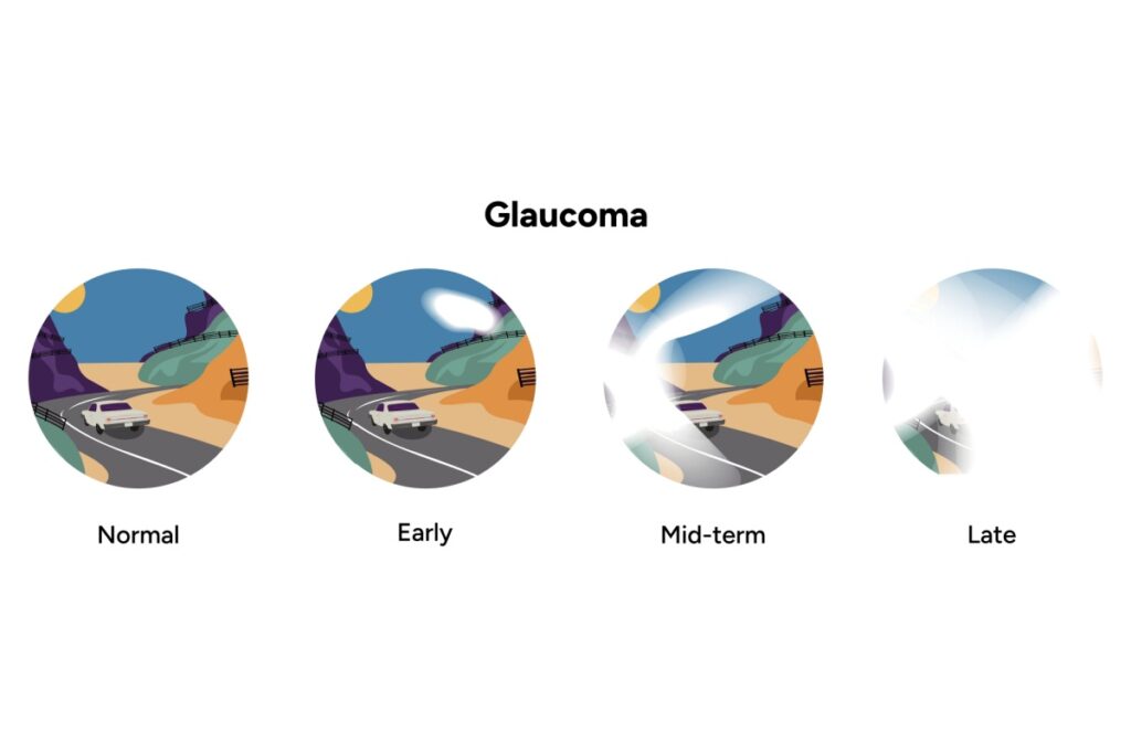 Glaucoma loss of vision progression.