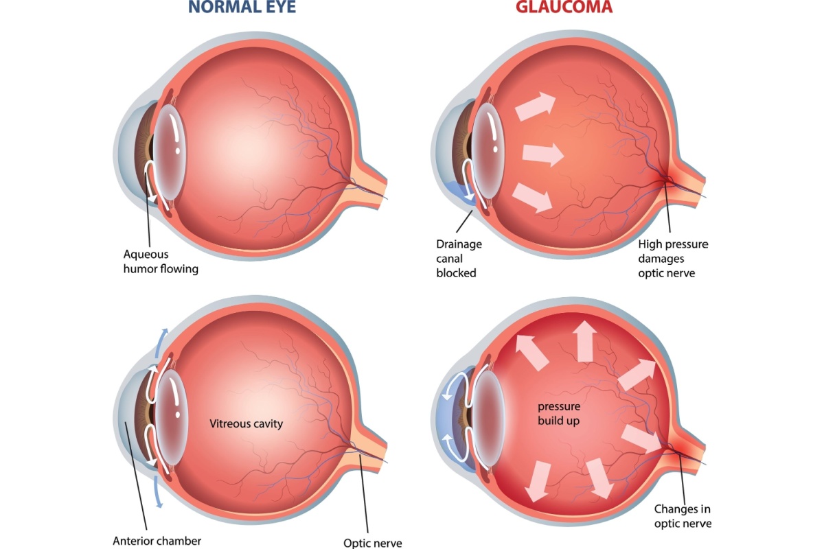 Normal eye vs glaucoma cross section illustration.